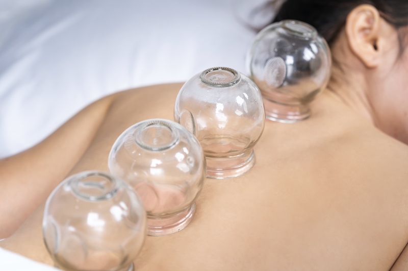 cupping treatments